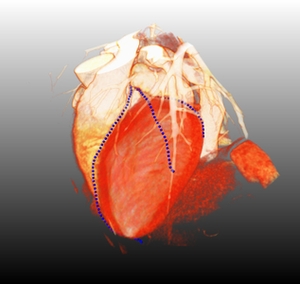 Two Point Minimum Cost Path Approach for CTA Coronary Centerline Extraction