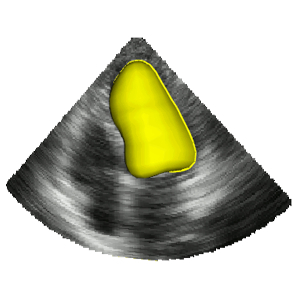 Real-time Tracking of the Left Ventricle in 3D Ultrasound Using Kalman Filter and Mean Value Coordinates